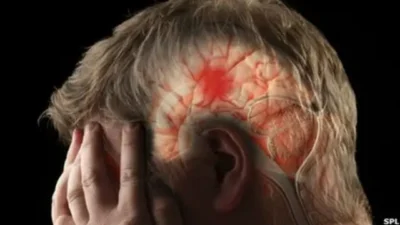 Las 3 señales de alerta de un derrame cerebral
