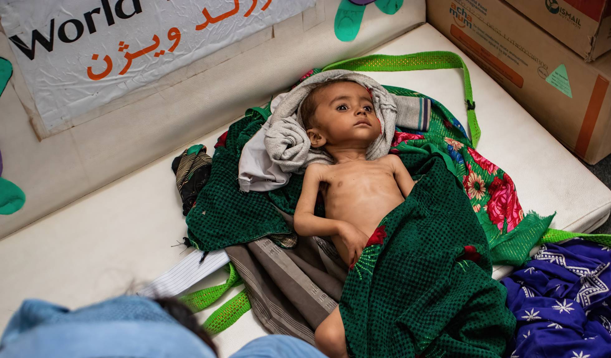 un millón de niños afganos pueden morir por desnutrición aguda severa