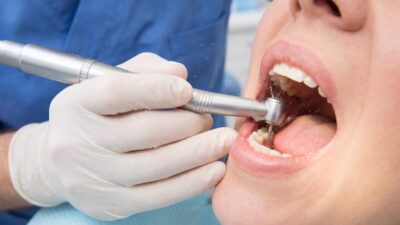 Cómo detectar filtraciones y daños en las carillas dentales