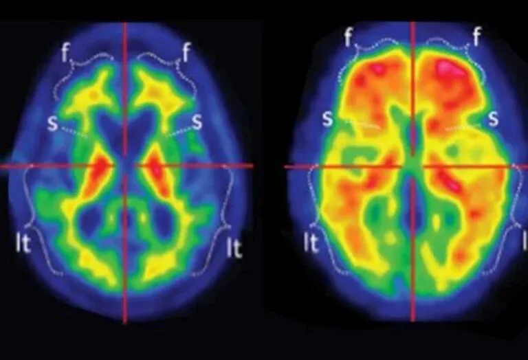 Alzheimer