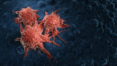 Productos cotidianos dejan partículas en pacientes con cáncer