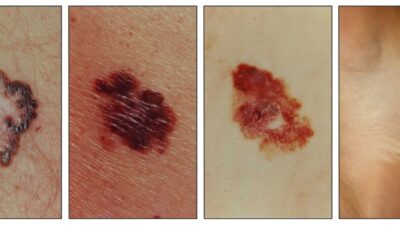 Diferencias entre carcinoma y melanoma, los cánceres de piel más habituales