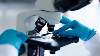 Descubren cómo anticipar el cáncer de próstata hasta 15 años antes