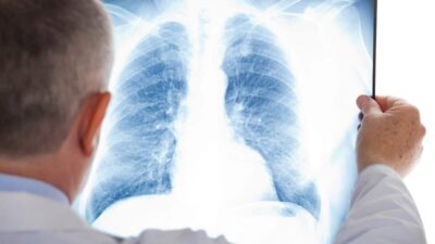 La ciencia encuentra nueva pista para detener el cáncer de pulmón