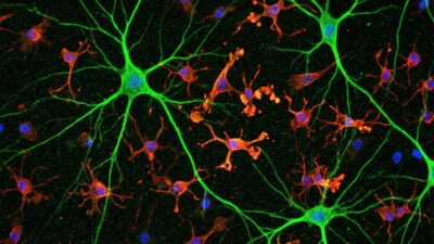 Nuevo hallazgo revela cómo el cerebro podría defenderse del Alzheimer