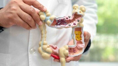 La conexión entre los pólipos intestinales y el desarrollo del cáncer