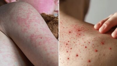 Rápido aumento de casos de sarampión alarma a Centroamérica
