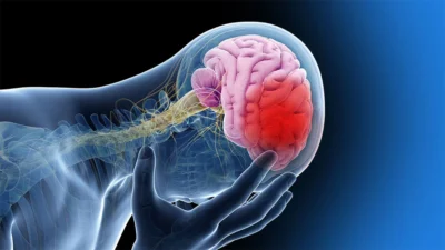 Aumentan los accidentes cerebrovasculares