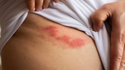 Costa Rica registra más casos de herpes zóster en mayores de 45