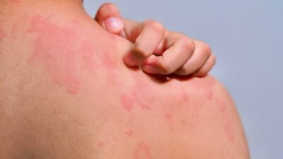 De bebés a adolescentes: cómo evolucionan las alergias alimentarias