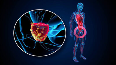 Cáncer de próstata: Una prueba podría guiar la terapia hormonal