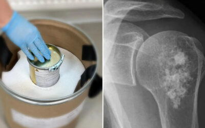 Rusia emplea innovador medicamento para el tratamiento de cáncer