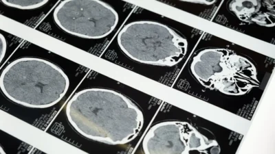 Lo que parecía un resfriado resultó ser meningitis