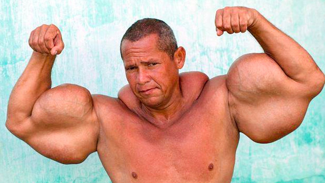 Muere el ‘Popeye brasileño’, famoso por inyectarse aceite mineral