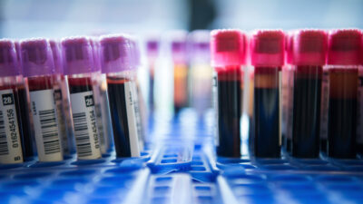 Una prueba de sangre podría predecir la supervivencia tras un infarto